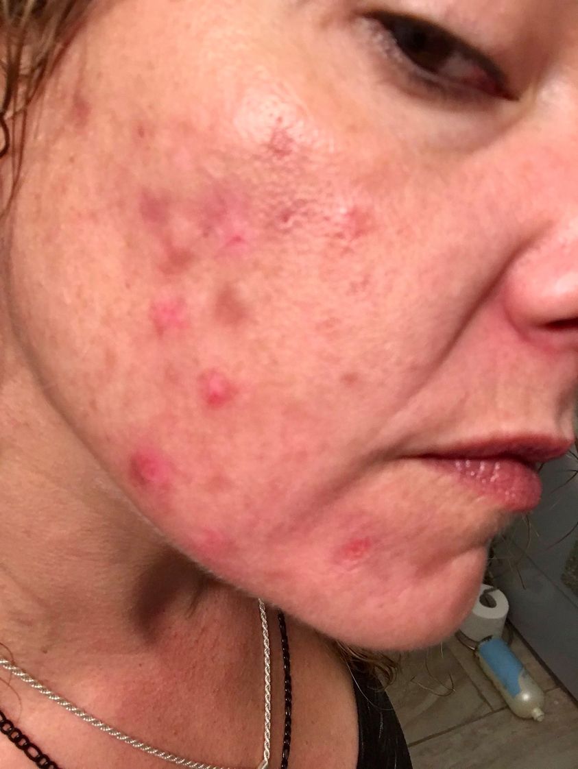 hormonal cystic acne