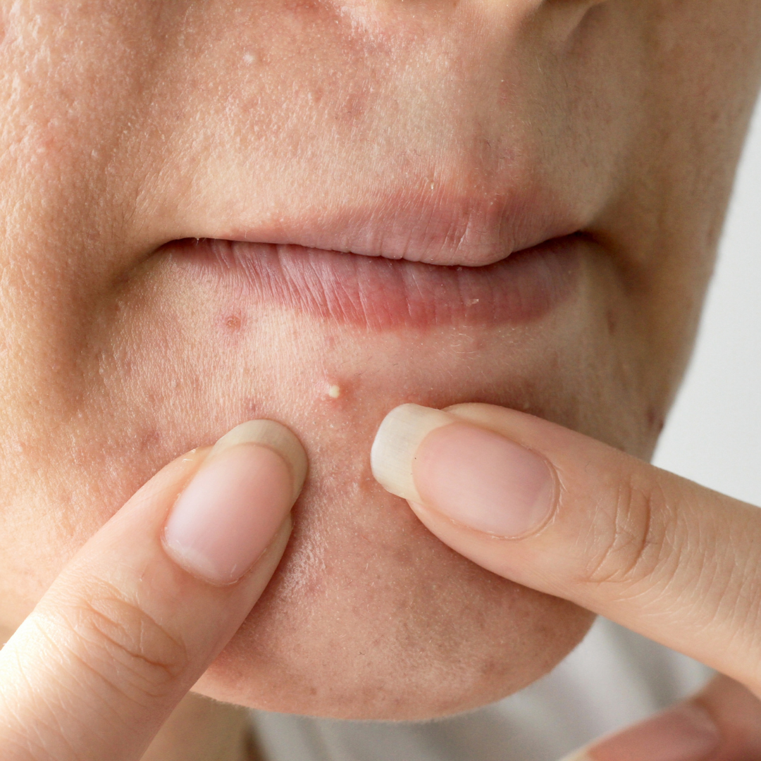 woman popping pimple